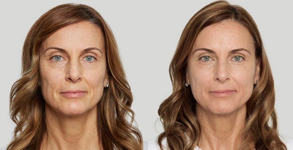 sculptra biostimulatoren clinic8