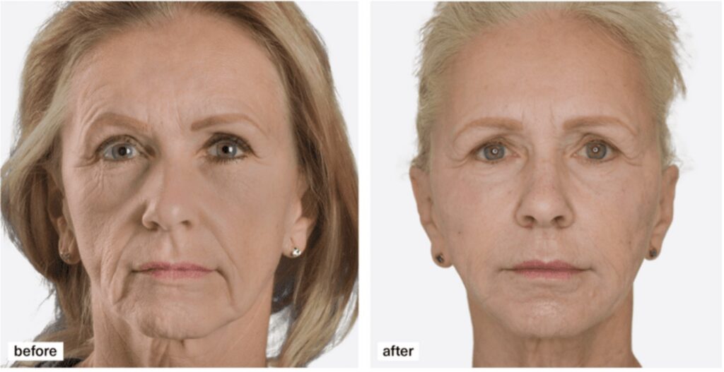 sculptra voor na vrouw clinic8 ninove okegem